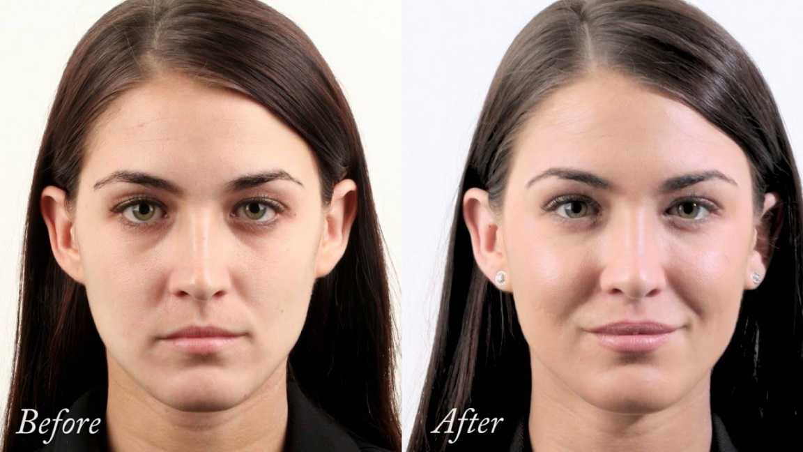 هزینه تزریق فیلر گونه